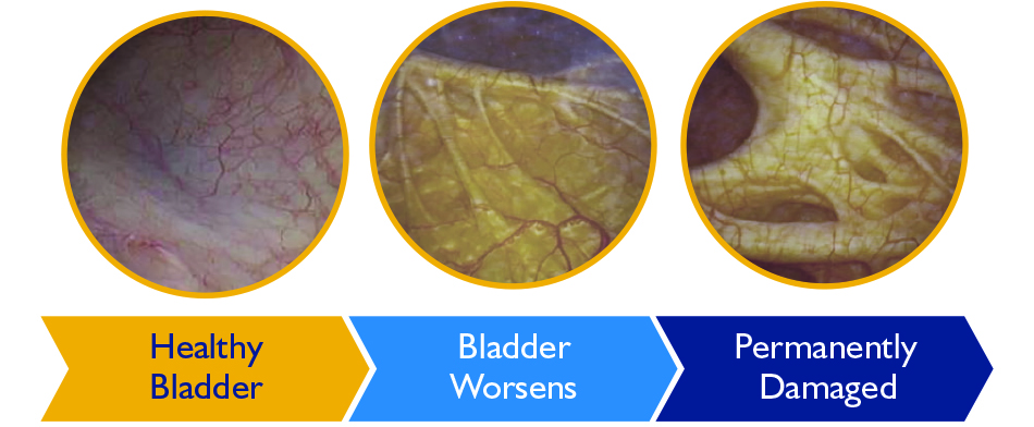 Bladder Damage Diagram
